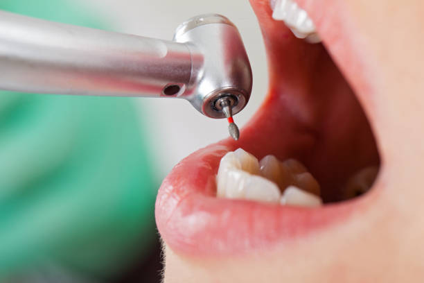 Best Knocked-Out Tooth (Avulsed Tooth) Treatment in Warren Af, WY